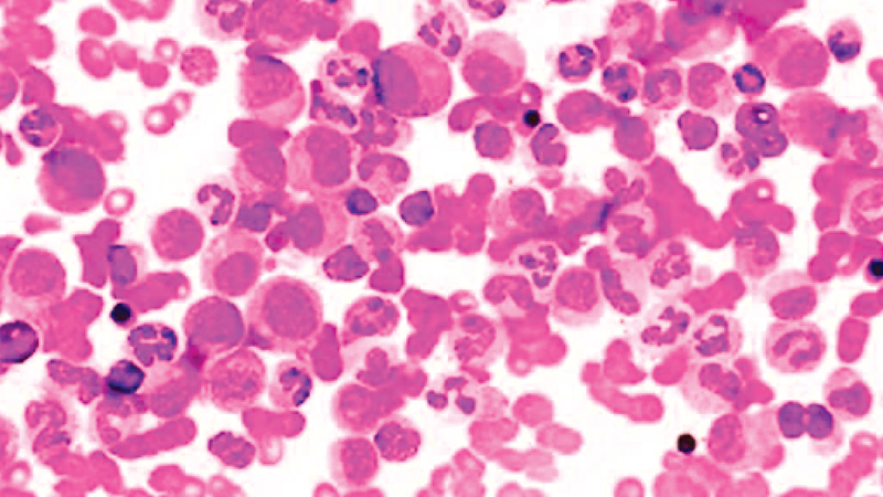 Chronic Myeloid Leukaemia