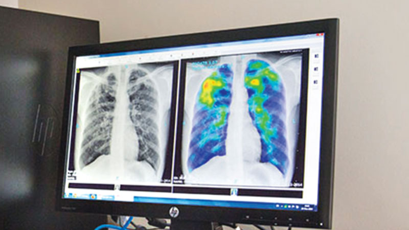 Hearing loss screening for patients with TB and diabetes urged