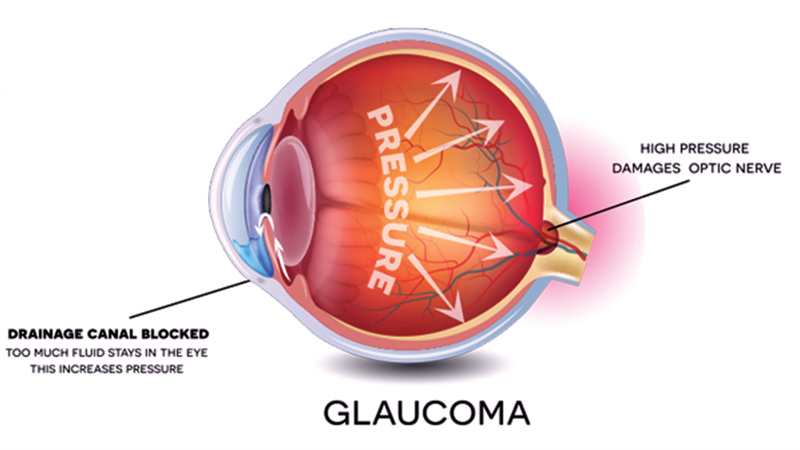 79 glaucoma specialists for 25 lakh patients across country