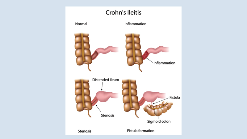 9 Things you should know about Crohn's disease