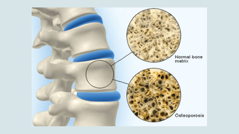 Osteoporosis: A silent epidemic! 
Public awareness is inevitable.
