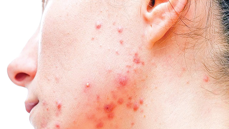 Acne advice for 
returning students
