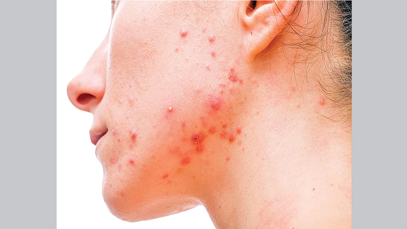 Acne advice for returning students
