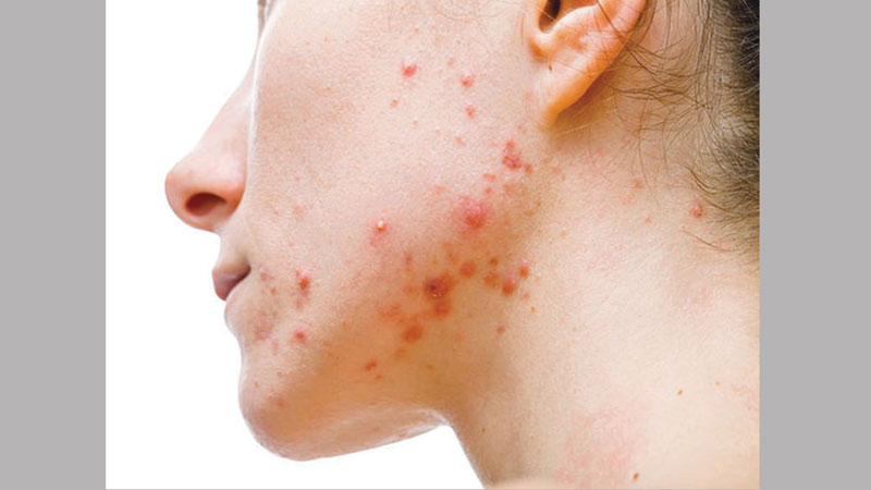 Acne yields up secret that 
points to new treatments
