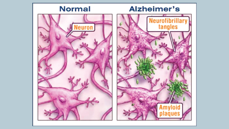 Alzheimer’s disease-A disease of irreversible memory loss
