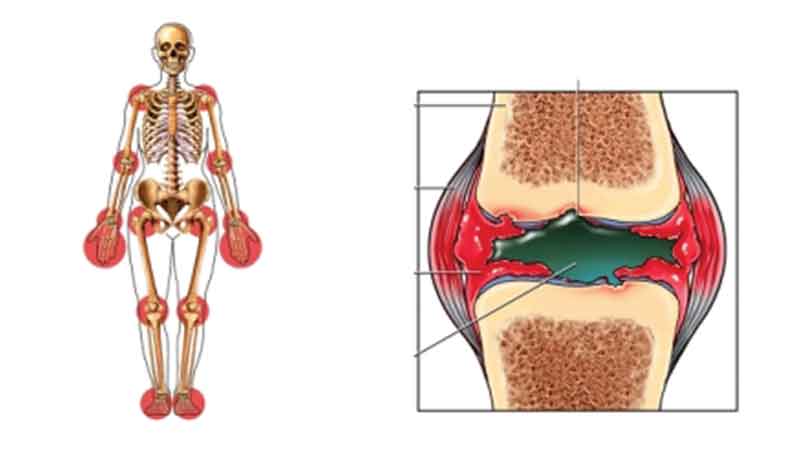 Arthritis treatment options