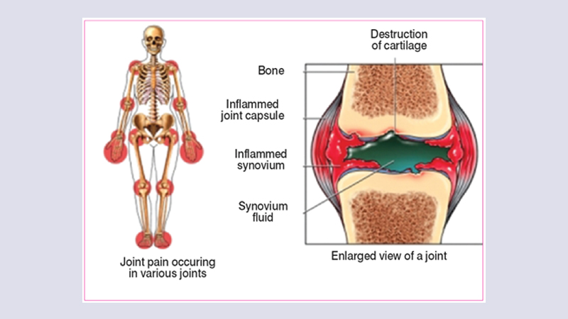 Arthritis treatment options