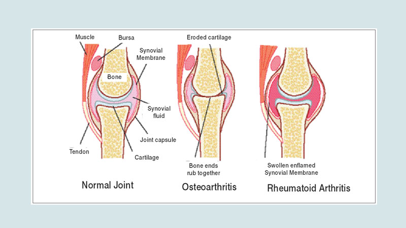 Arthritis