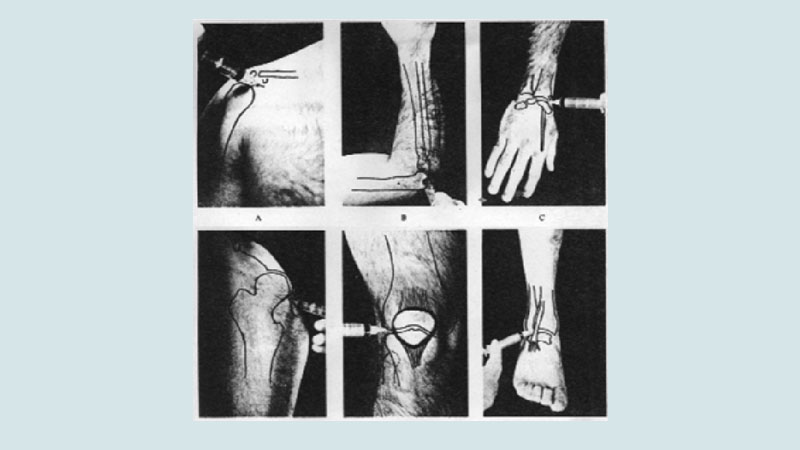 Arthrocentesis and joint injections