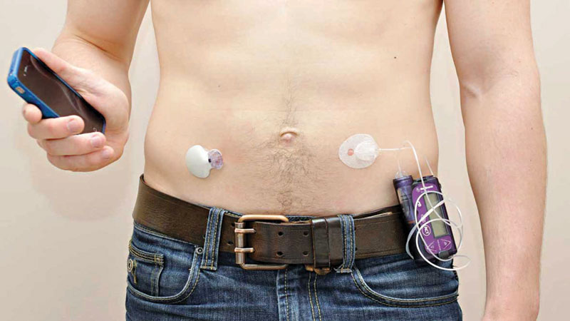 Artificial pancreas works well in home trial