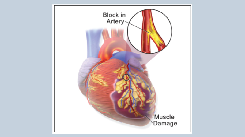 Beta blockers not needed after heart attack if other medications taken
