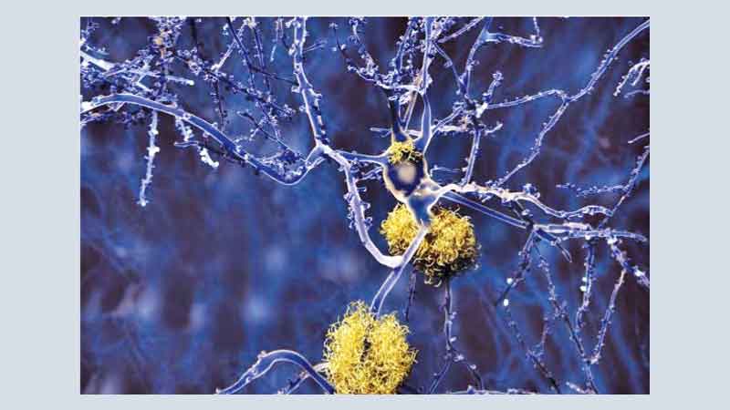 Blood pressure drug may treat early Alzheimer's disease