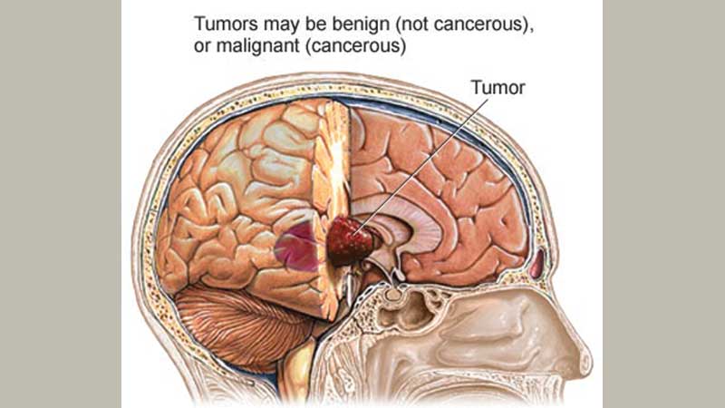 Brain tumours in adults