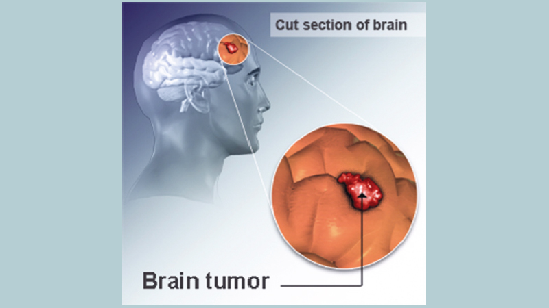Brain tumours and brain cancer