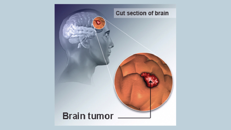 Brain tumours and brain cancer