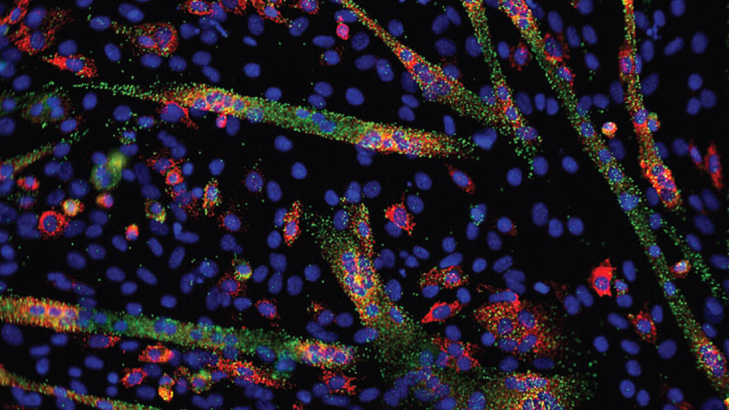Brains of people with autism share 
similar pattern of abnormal gene activity