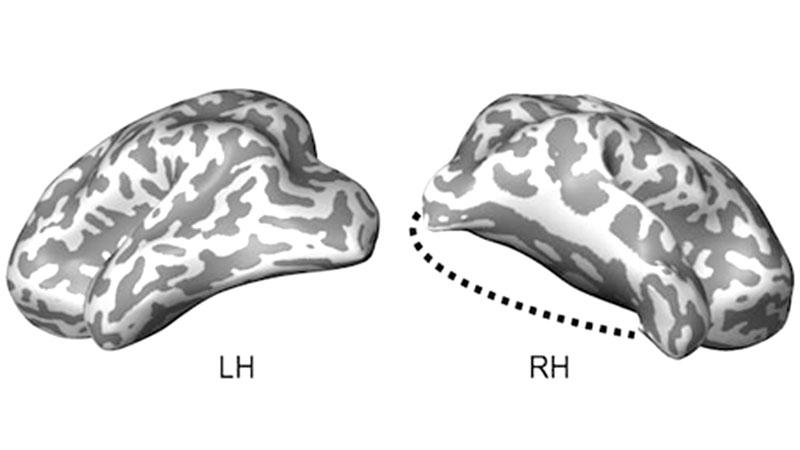 Brain’s ‘plasticity’ amazes 
as boy recovers from 
drastic surgery
