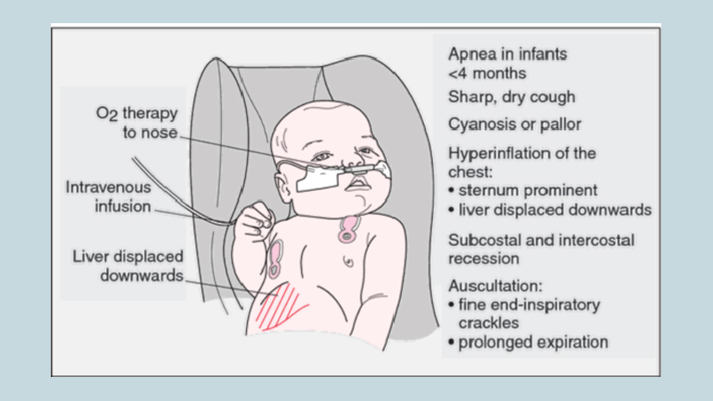 Bronchiolitis: Not to be treated lightly