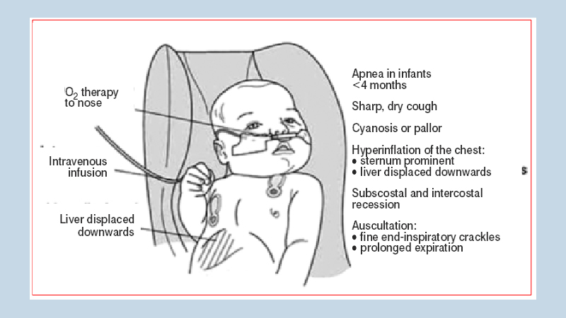 Bronchiolitis: Not to be treated lightly