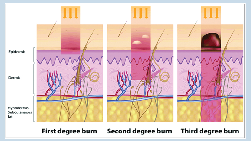 Burn injuries: A guide for patients 