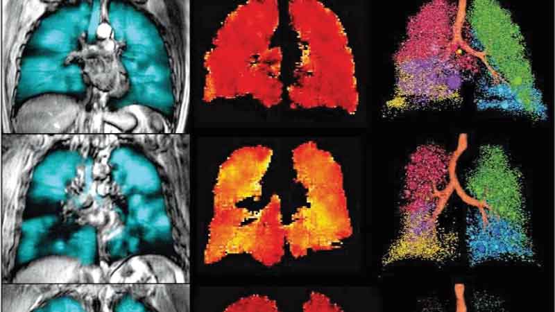 Imaging could improve treatment of people with COPD