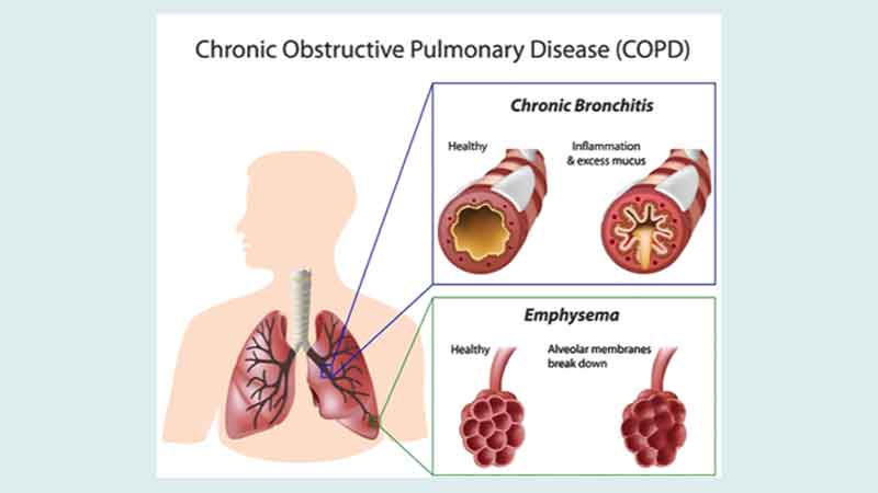 What are the signs and symptoms of COPD?