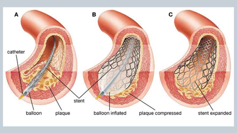 Cardiac catheterisation and coronary angioplasty