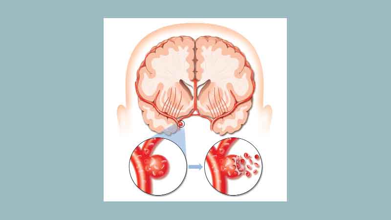 Cerebrovascular disorder