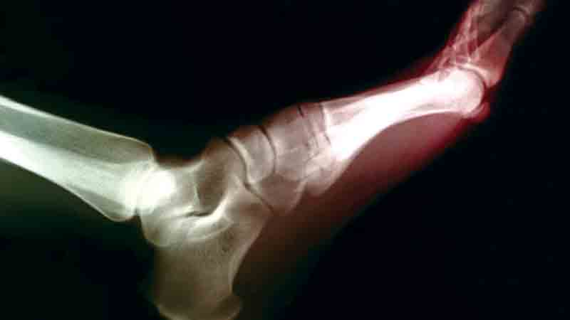 Certain diabetes 
medicines may 
lower gout risk
