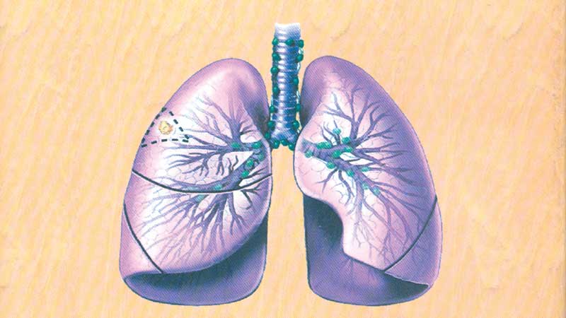 Reflections on TB and chest diseases