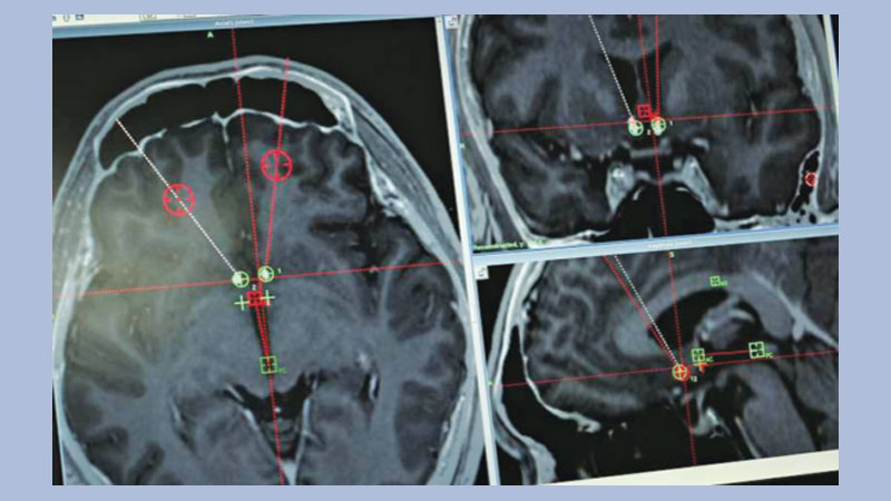 Chinese researchers try brain implants to treat drug addicts