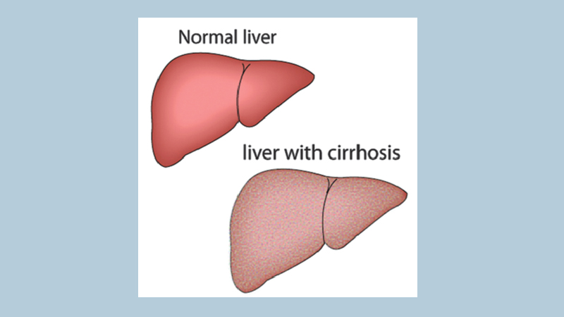 Cirrhosis