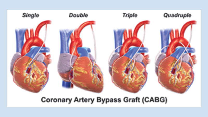 Coronary artery bypass grafting