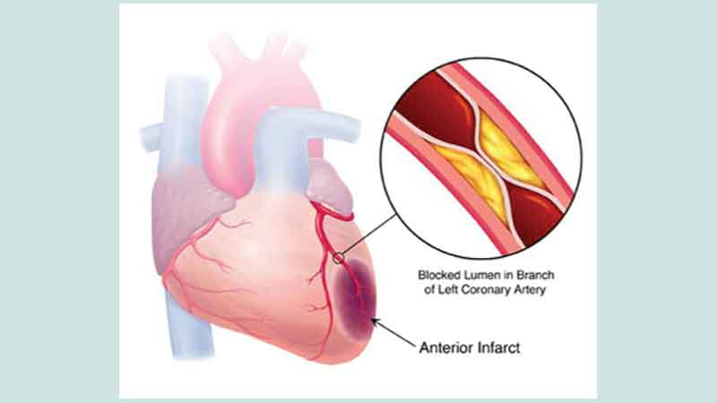 Coronary cardiovascular disease: an overview