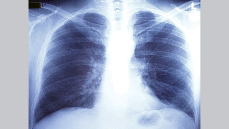 Could green tea extract help fight 
pulmonary fibrosis?
