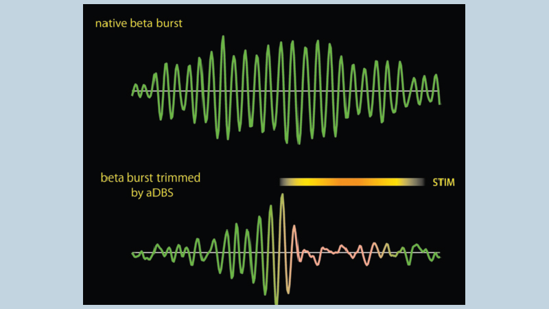Deep brain stimulation: a light of hope for Parkinson’s patients