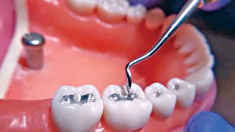 Experts for banning amalgam by 2016