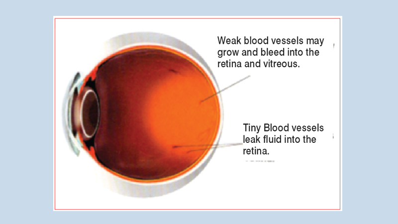 Diabetes and your eyes
