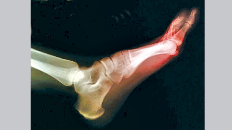 Eat this diet to 
lower your odds 
for painful gout