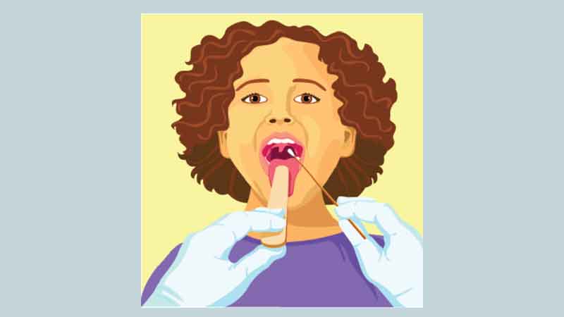 FAQ on streptococcal infections