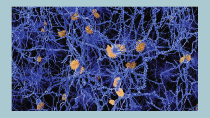 'Flashing light therapy' for Alzheimer's
