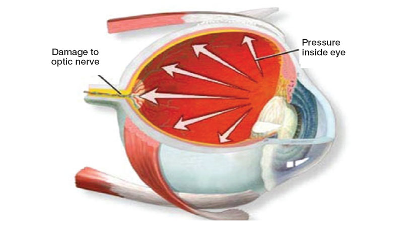 Glaucoma