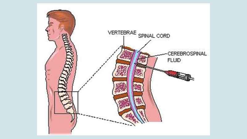 What is Guillain-Barr� Syndrome?