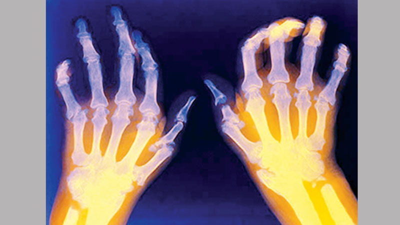 Rheumatoid arthritis facts