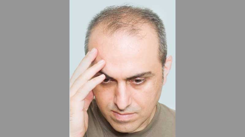 Drugs used in cancer, arthritis may help fight hair loss