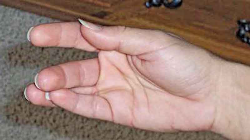 Hypocalcaemia