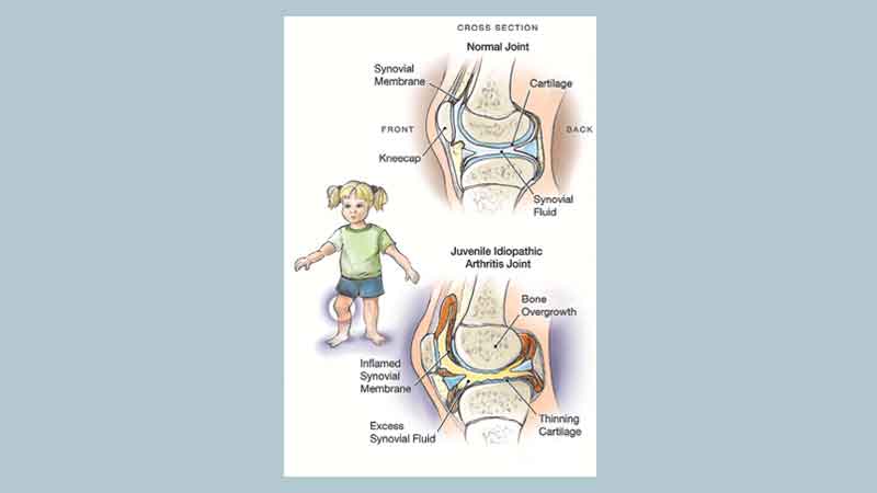 Juvenile rheumatoid arthritis and occupational therapy