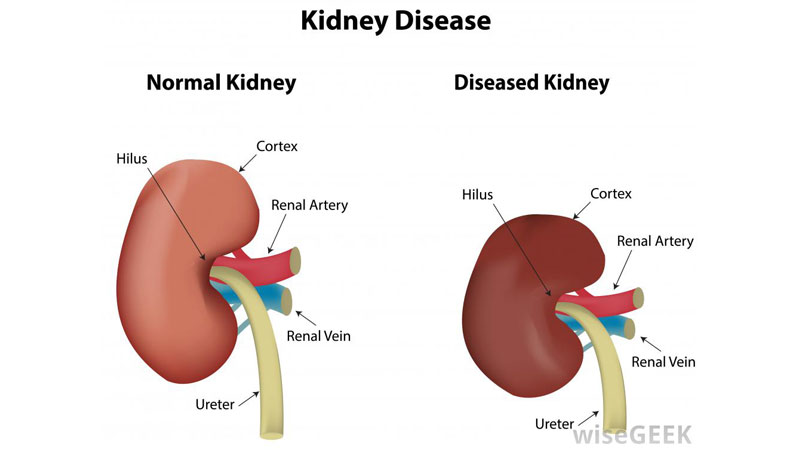 Kidney diseases
