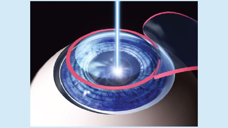 Lasik eye surgery
