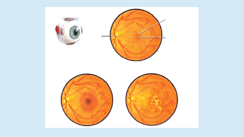 Macular degeneration 